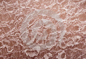 Unhealthy human skin epidermis texture with flaking and cracked