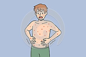 Unhealthy man have red spots suffer from illness