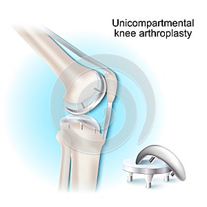 Unicompartmental knee arthroplasty