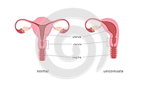 Unicornuate and normal healthy uterus comparison chart. Congenital malformation of female reproductive system.