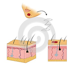 Repair, complex of chin, 2.6 cm to 7.5 cm Z-plasty photo