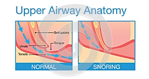 Upper airway human anatomy in sleeping