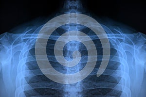 Upper Body X-Ray