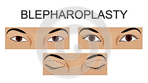 Upper eyelid blepharoplasty