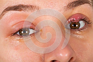 Upper eyelid infection - chalazion