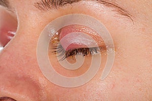 Upper eyelid infection - chalazion