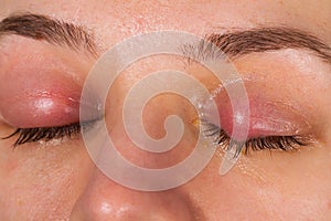 Upper eyelid infection - chalazion photo