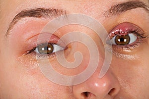 Upper eyelid infection - chalazion photo