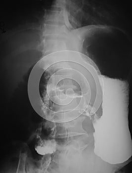 Upper gastro-intestinal (UGI) study of a 55 years old man, demonstrated post jejunum obstruction of contrast media.