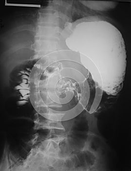 Upper gastro-intestinal (UGI) study of a 55 years old man, demonstrated post jejunum obstruction of contrast media.