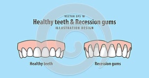 Upper healthy teeth & Recession gums illustration vector
