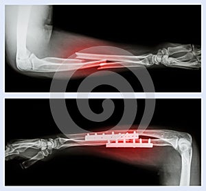 Upper image : Fracture ulnar and radius (Forearm bone) , Lower image : It was operated and internal fixed with plate and