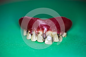 Upper jaw prosthesis