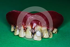 Upper jaw prosthesis
