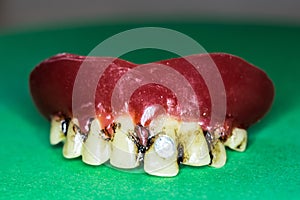 Upper jaw prosthesis