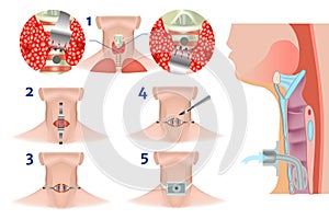 Upper and lower tracheostomy. Tracheal surgery.