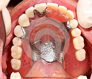 Upper Prosthesis In Mouth