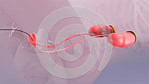 Ureteroscopy and laser lithotripsy for renal stones photo