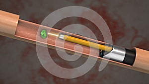 Laser lithotripsy with ureteroscopy for the treatment of kidney stones photo