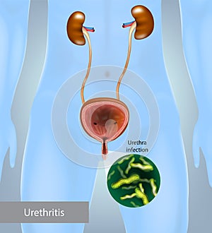 Urethritis is the inflammation of the urethra. Gonococcal urethritis. Urinary tract infection.