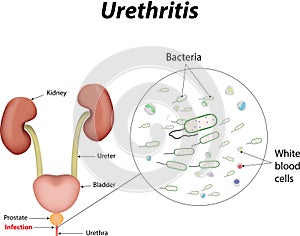 Urethritis