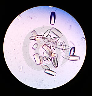 Uric Acid crystals