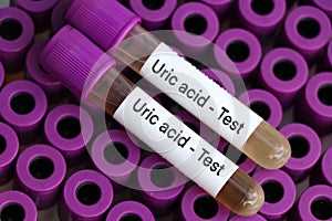 Uric acid test to look for abnormalities from Urine, Urine sample to analyze in the laboratory