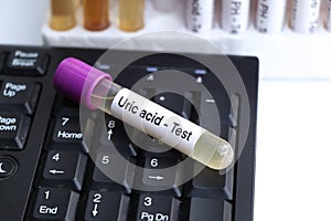 Uric acid test to look for abnormalities from Urine, Urine sample to analyze in the laboratory