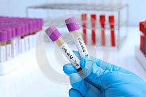 Uric acid test to look for abnormalities from Urine, Urine sample to analyze in the laboratory