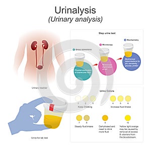 Urinalysis urinary analysis The lab test dips the strip into urine, chemical reactions change the colors.