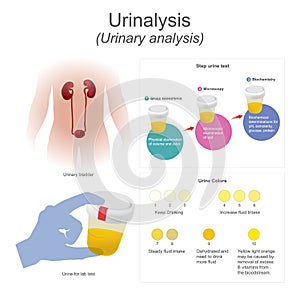 Urinalysis urinary analysis The lab test dips the strip into urine, chemical reactions change the colors. photo