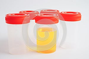 Urinalysis, urine cup for check health examination in laboratory