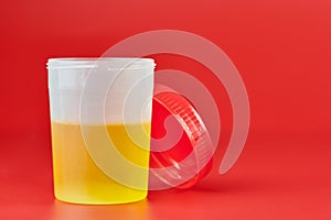 Urinalysis for urolithiasis in container