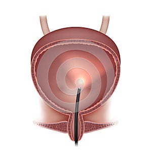 Urinary bladder examination