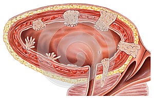 Urinary Bladder & Wall - Cancer photo