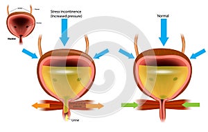 Urinary incontinence UI, also known as involuntary urination.