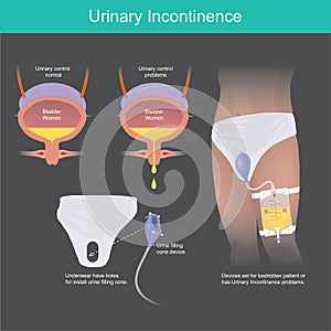 Urinary Incontinence. Urine filling cone device. photo