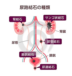 Urinary stones ( Kidney stones ) illustration