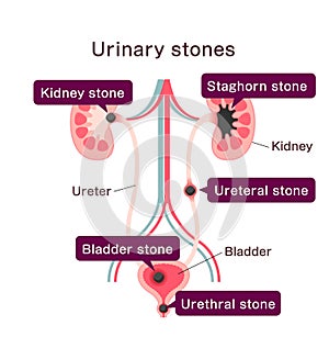 Urinary stones ( Kidney stones ) illustration