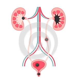 Urinary stones ( Kidney stones ) illustration