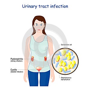 Urinary tract infection. cystitis, and pyelonephritis