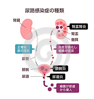 Urinary tract infection illustration