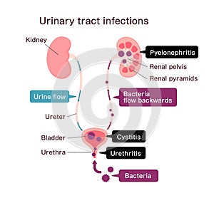 Urinary tract infection illustration