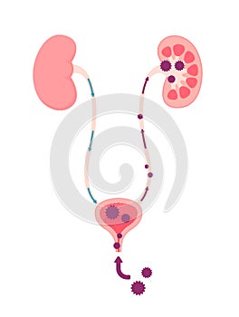 Urinary tract infection illustration