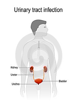 Urinary Tract Infection. pyelonephritis.