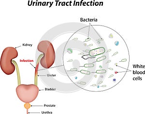 Urinario tracto infecciones 