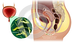 Urinary Tract Infections in Women. Bacteria coming from the rectum found in bladder and urethra. Escherichia coli