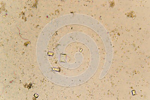 Urine crystals, red blood cells and leukocytes at the microscope. Urinary tract disease in cat