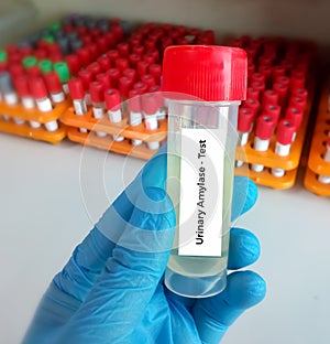 Urine Sample for Urinary Amylase test with laboratory background. Closeup.