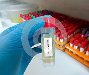 Urine Sample for Urine PCR (Protein Creatinine Ratio) test. Closeup. Urinalysis.